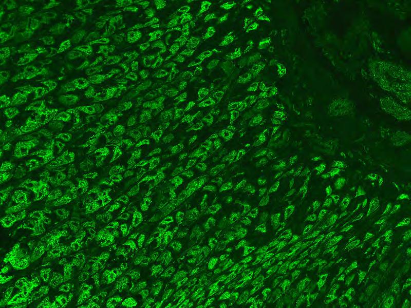 3. Az antitestek szöveti antigének ellen termelődnek Megnevezés Klinikai jellegzetesség Ab specificitás anemia perniciosa Sokáig lappangó betegség.