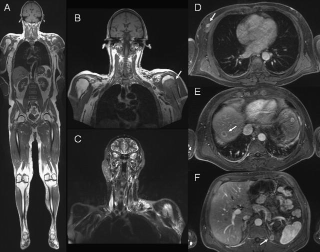 Teljes test MRI a daganatok