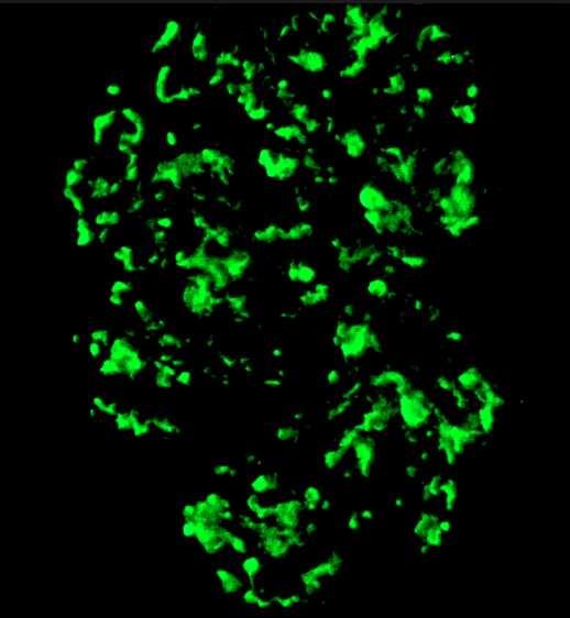 immunglobulin pozitívitás esetén (Type II) pauci-immun vagy