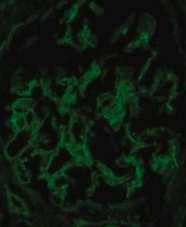 pathogenesisében az immunrendszer nem venne részt de a Pauci-immun