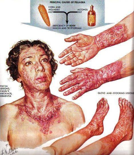 B3 vitamin hiány: