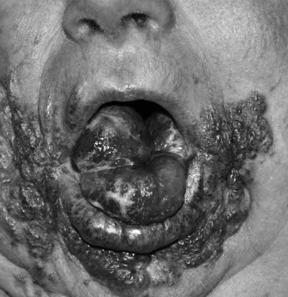 Morbidity related to the treatment was seen only in one case 10. The patient developed severe headaches and hydrocephalus following BiPAP therapy.