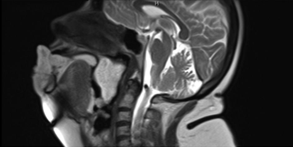 Figure 2. Sagittal, T2-weighed MR image of the patient shows the vascular mass on the labial region and on the soft palate causing the narrowing of the airways Figure 4.