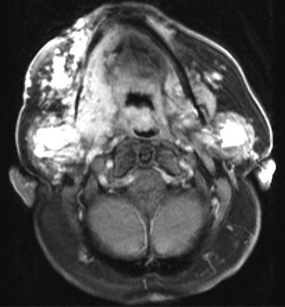 Horizontal, T1-weighed, contrast enhanced MR of the patient showing the vascular laesion on both sides (buccal, parotid region, sublingual region) and the decreased antero-posterior pharyngeal