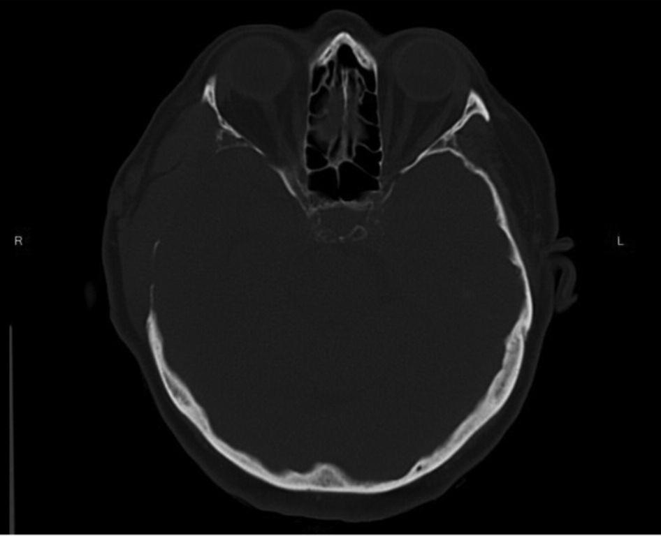the hemangioma mass. The epidural propagation of the hemangioma can cause the chronic irritation of the temporal cortical area with the possible consequence of epileptic discharge.