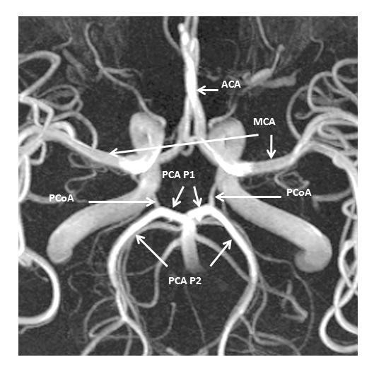 3. ábra Az intrakraniális nagyerek MR angiográfiás képe. Jól látható, hogy a PCA P1-es szakasza előre és lateralis, P2 szakasza hátra és lateralis, majd hátra és mediális irányba halad.