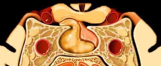 tumorok Hypothalamus glioneuronalis