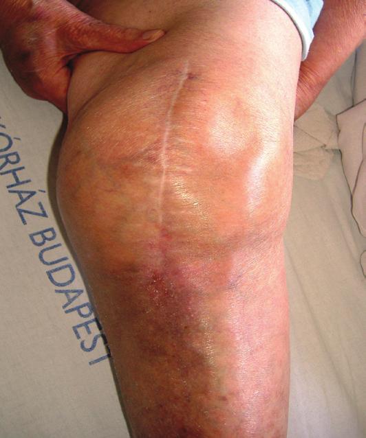 intraoperatív