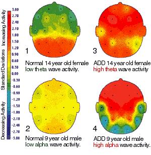 ADHD agy - EEG képe
