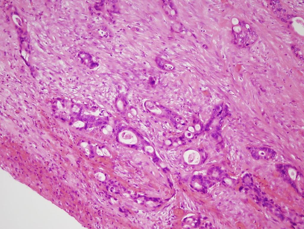 Adenocarcinoma