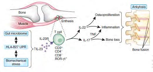 enthesitis