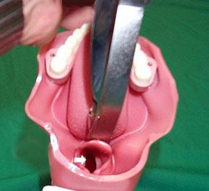 Intubálás laringoszkóppal 1. A laringoszkóp nyelét bal kézzel marokra fogjuk, és a lapocot a nyelv középvonalában a szájüregbe vezetjük, ha szükséges, a nyelvet a Z lapoccal balra félretoljuk; 2.