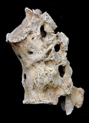 Vertebral tuberculosis Tuberculous