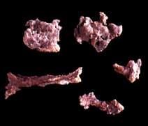 Calcifications of tuberculous origin - rare