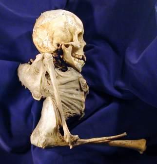 Paleoepidemiology of TB Hungary - 18-19th century mummy