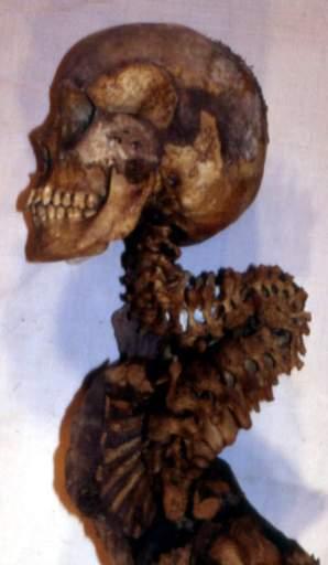 Case 39 Partially mummified remains of an 18-yearold male.