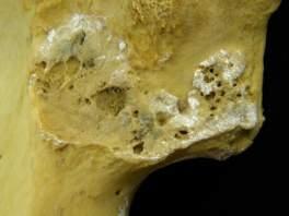 individuals, who had died of TB at a young age