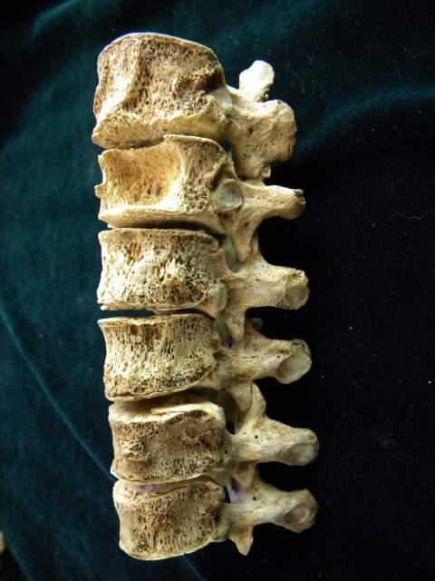 Death: vertebral TB