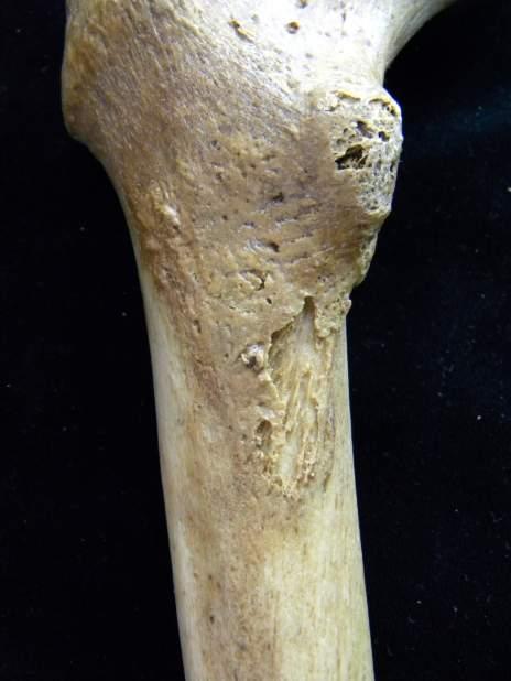 Death: vertebral TB