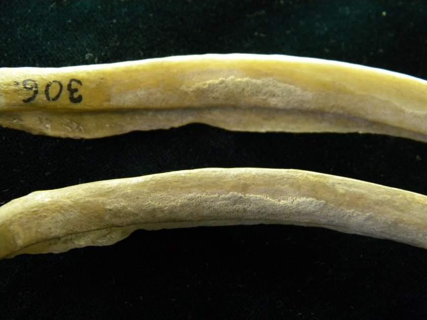 No. 306, White Female, 17 Years, lung TB