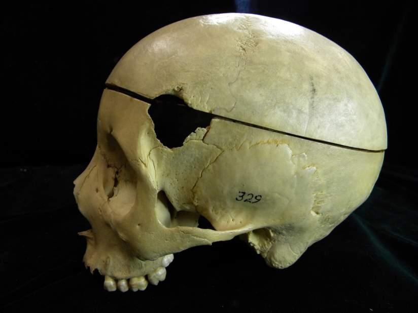 No. 329, Black Male, 17 Years, TB, cranial lesions,