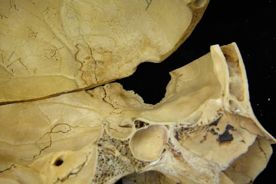 No. 329, Black Male, 17 Years, TB, cranial lesions, syphilis?