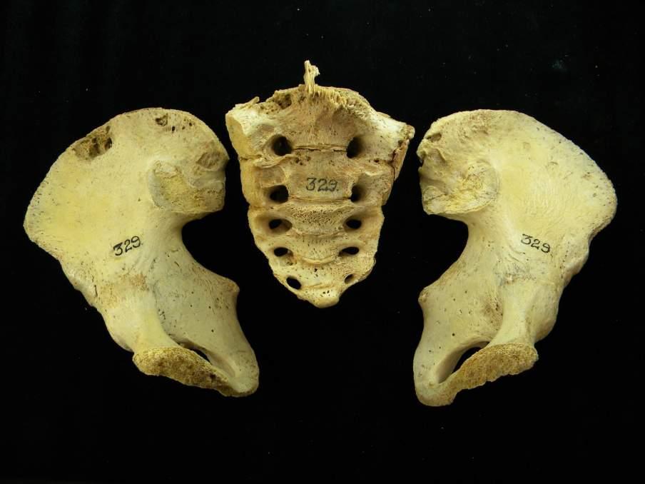 No. 329, Black Male, 17 Years, TB, cranial lesions,