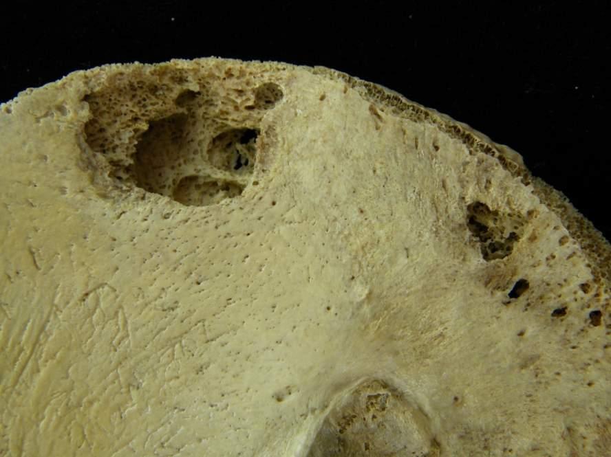 No. 329, Black Male, 17 Years, TB, cranial lesions,