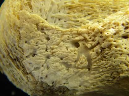 lesions, syphilis?