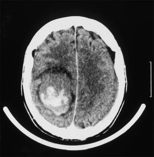 Késői relapszus Definició tumor visszatérés > 2 év komplett remisszió után Késői relapszus Miért fontos?