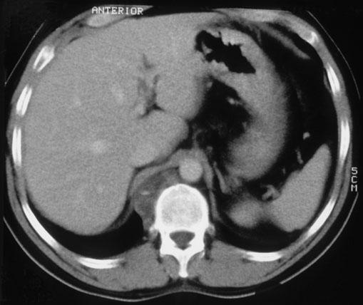 mediastinalis : kezelése gyógyszeres NS