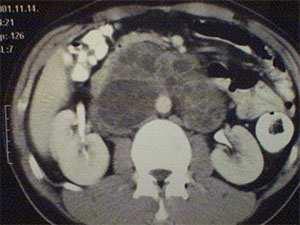 in situ) pt1 A tumor a testisre és a mellékherékre terjed és nincs vascularis lymphaticus érinvaso.