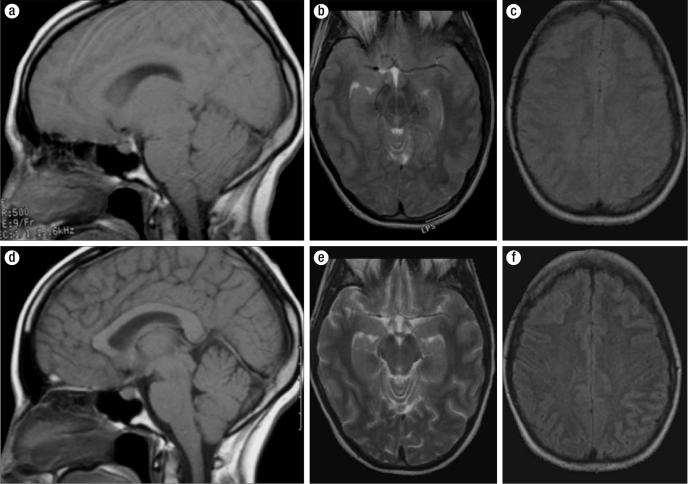 MR felvételek fizikai edzést követő hyponatremiában edzést követő hyponatremia hyponatremia rendezése után Comparison of MR images during the episode of exercise-associated hyponatremia (top row) and