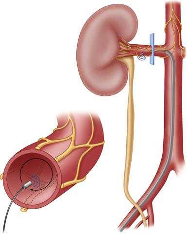 A vese beidegzés radiofrekvenciás megszüntetése Percután kathéteres renalis denerváció: - Vese artéria angiographia: van-e stenosis - Catether az artéria disztális részébe - Kontaktus keresés az