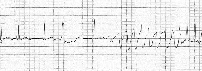 Drug induced arrhythmia, I Kr associated risk of Torsade de Point (TdP) and sudden cardiac death in LQTS Drug LQTS EADs EBs Original ECG from 47 years old female TdP Az AP-k és EKG-k görbén is