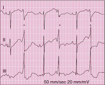 LQTS Pathophysiology EAD- R on T VT DAD Reentry- vortex like