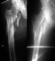 Subtrochanter femur törések az összes csípőtáji törés 10-20 %-a A kis trochanter alatt kb 3-5 cm-rel, ráterjedhet a trochanterre és/vagy a