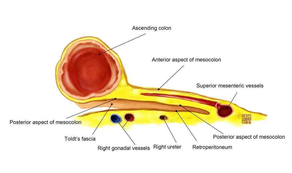 CME - complete mesocolic excision Hohenberger és munkatársai 1329 beteg adatai alapján mutatták ki hasznosságát Helyi kiújulás