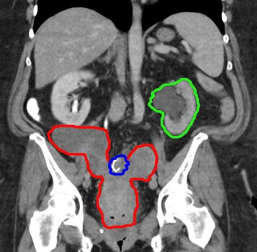 tumor