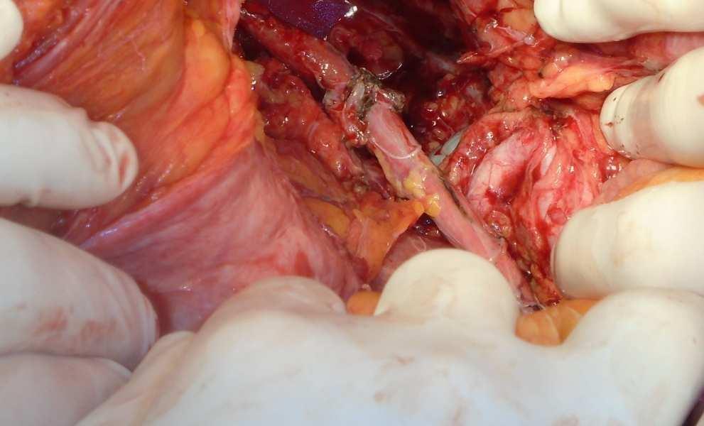 tumor