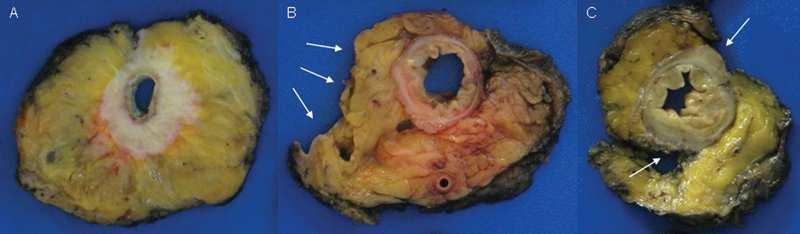 a mesorectum