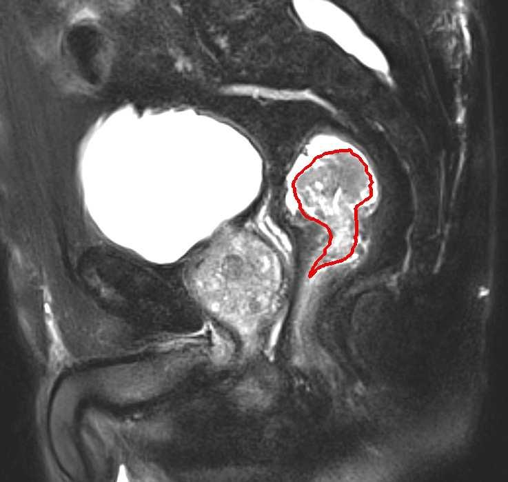 Még egy probléma: nagy, benignus rectum Dilemma Obligát precancerosis polyp Endoscoppal nem