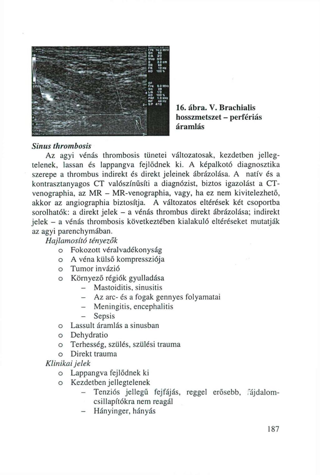 16. ábra. V. Brachialis hosszmetszet - perfériás áramlás Sinus thrombosis Az agyi vénás thrombosis tünetei változatosak, kezdetben jellegtelenek, lassan és lappangva fejlődnek ki.