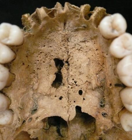 kép: Kiszélesedett apertura piriformis (számnélküli, adultus,
