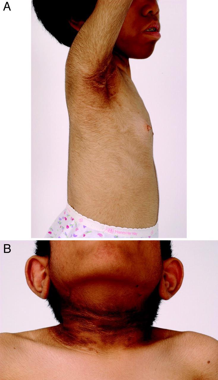Rabson-Mendenhall szindróma AR, INS-R Inzulin receptor hiba Inzulin rezisztencia Éhezési hypoglicaemia és postprandrialis hypreglicaemia Acanthosis nigricans,