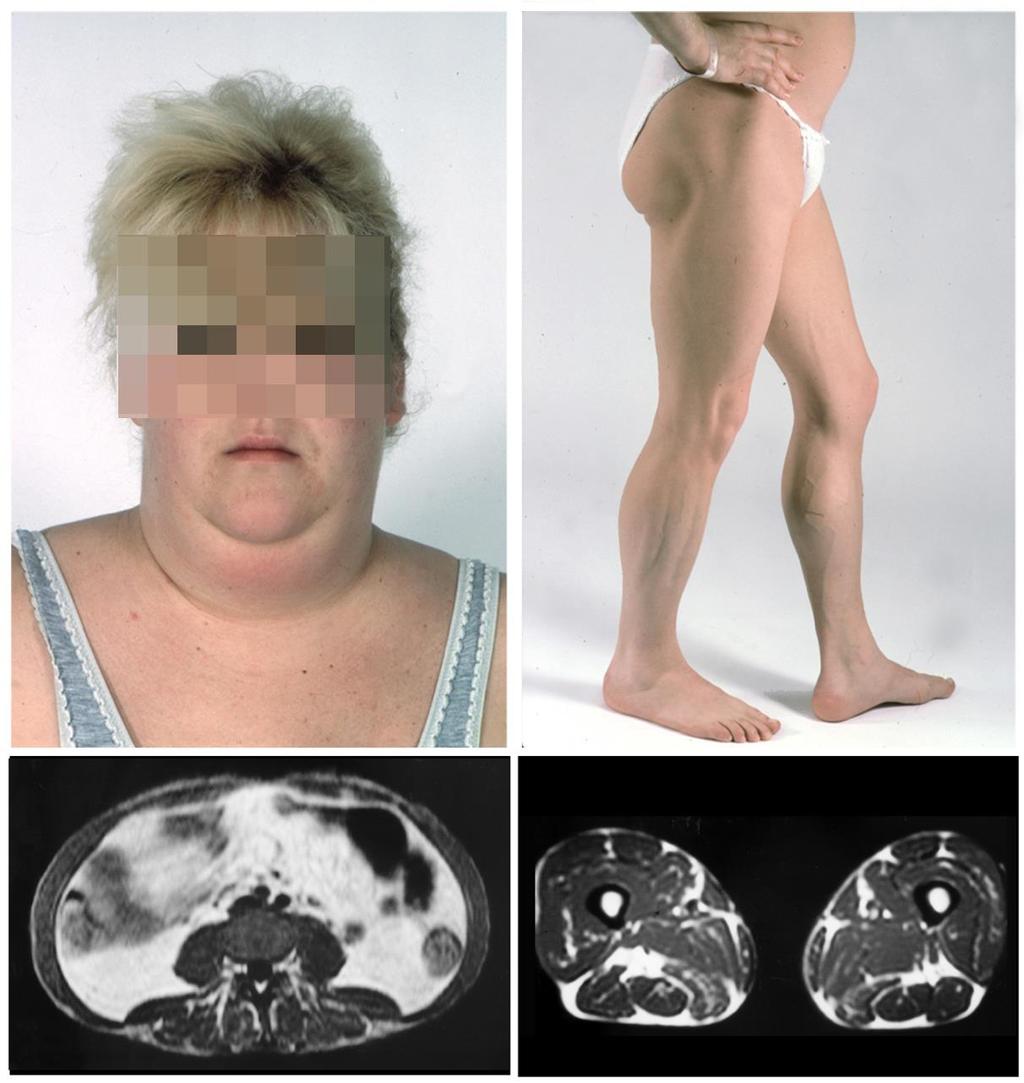 Familiaris parciális lipodisztófia (Dunningan típus) Progresszív szubkután zsírszövet vesztés a