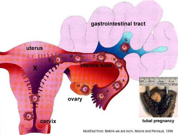 Elnevezés hely szerint, 94% tuba uterina Okai: zona pellucida korai leválása,