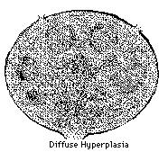 Reaktív lymphadenopathia Benignus, reverzibilis, szekunder nyirokcsomómegnagyobbodás - hyperplasia Többféle morfológiai mintázat lehetséges