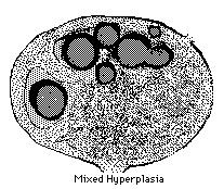 Diffúz paracorticalis hyperplasia T-sejtes válaszreakció Paracorticalis és interfollicularis zónák expanziója Heterogén sejtpopuláció, egyik