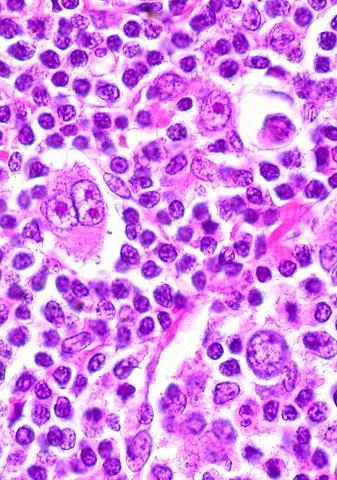 Hodgkin-lymphoma